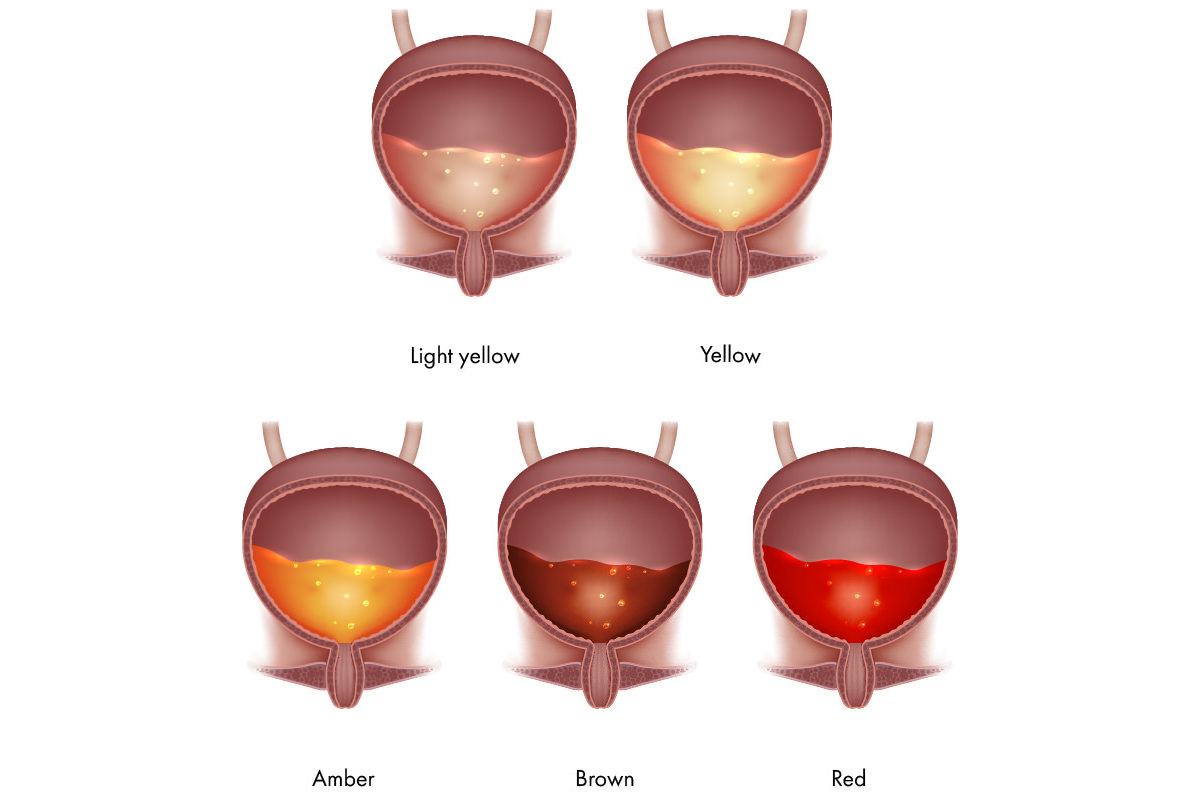 तपाईंको पिसाबको रङ्ग कस्तो छ ? रङ्ग हेरेर स्वास्थ्य अवस्था थाहा पाउनुहोस्