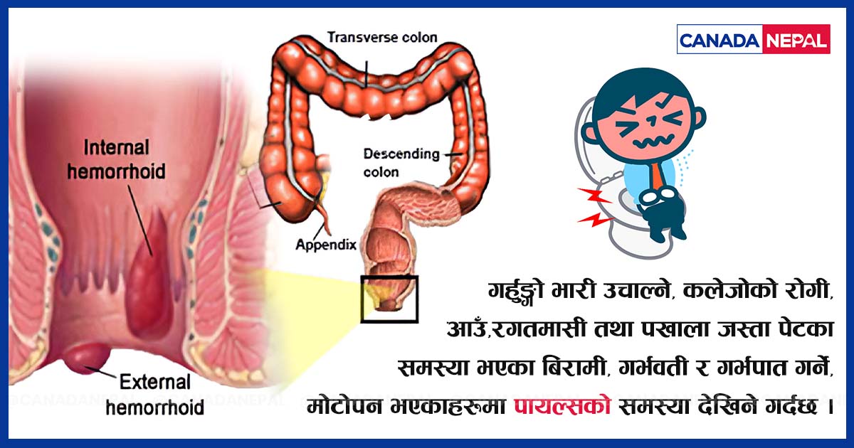 पायल्स के हो ? यो रोग भएकाले के गर्ने, के नगर्ने